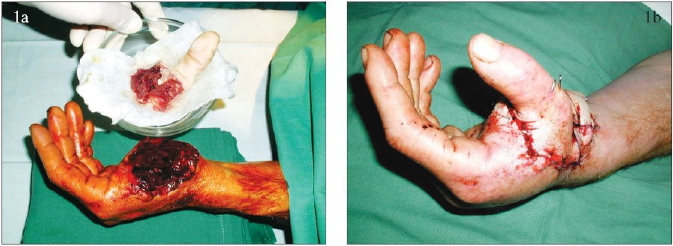 Replantace palce ruky: a – amputovaný palec, b – stav po replantaci.
Fig. 1. Thumb replantation: a – amputated thumb, b – post- replantation condition.

