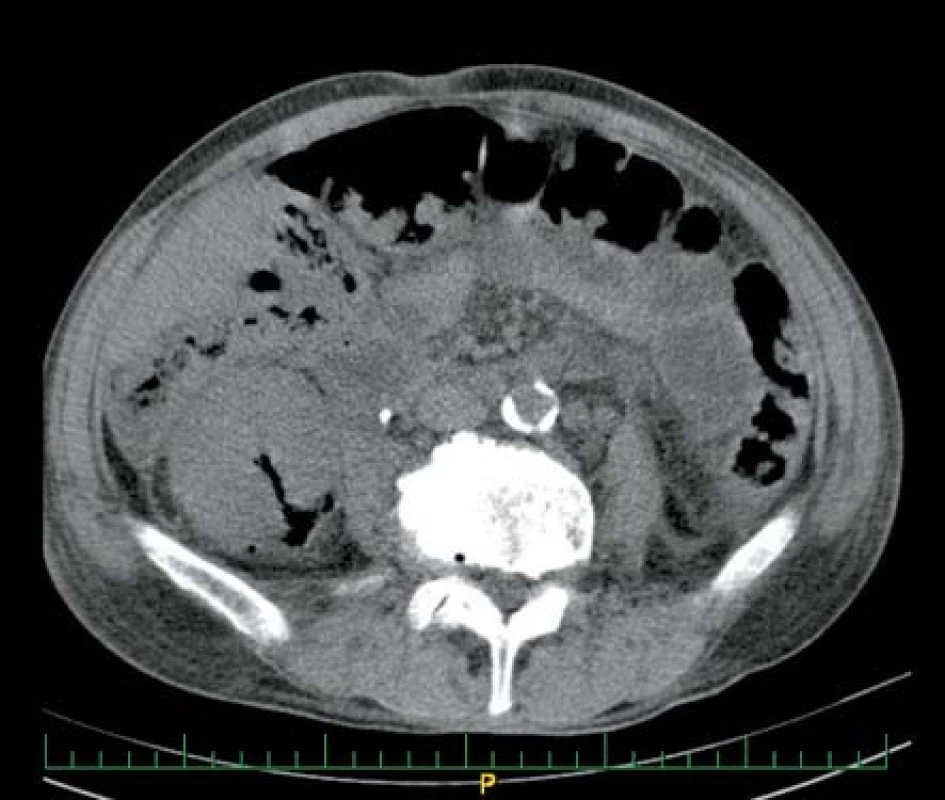 Ložisko plynu v pravé ledvině u muže středního věku
Fig. 2. Gas in right kidney in middle age man