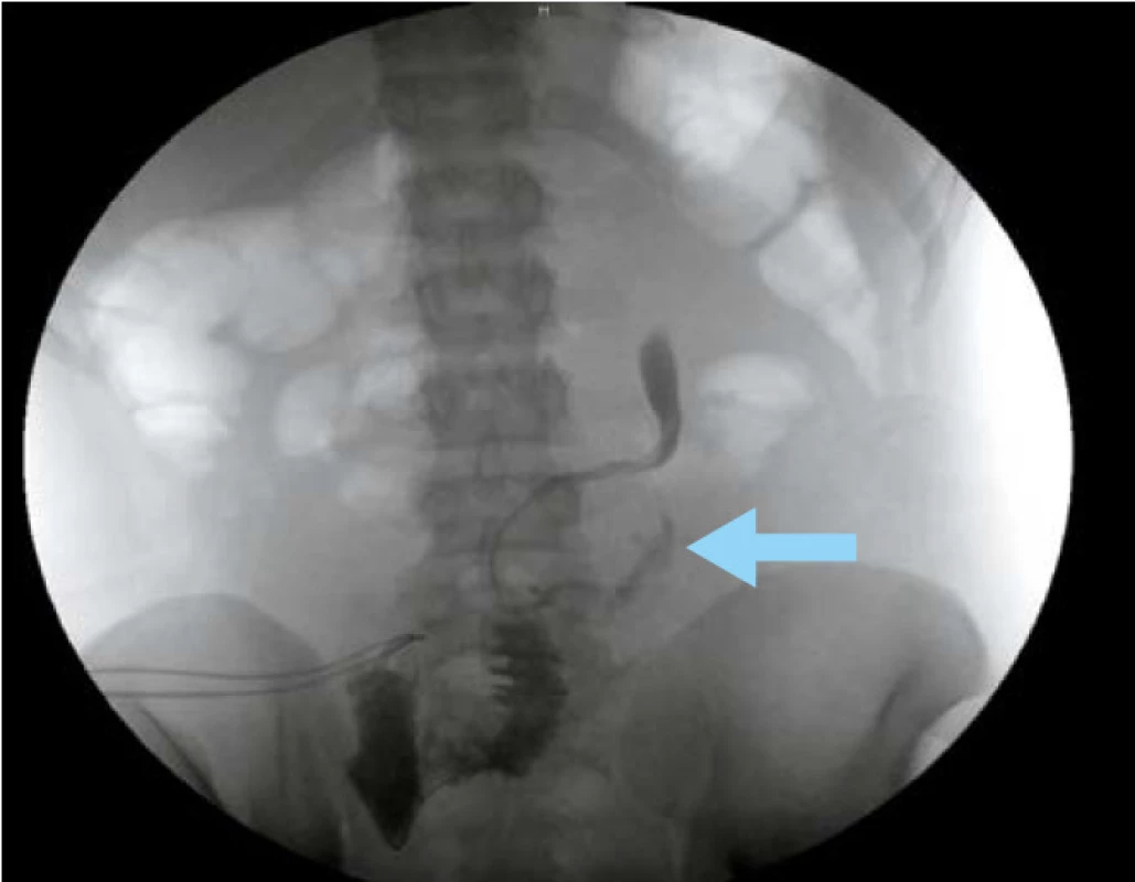 Urinózní leak v místě ureteroileální anastomózy (znázorněn šipkou)
Fig. 2. Urinary leakage at the site of the ureteroileal anastomosis (indicated by arrow)