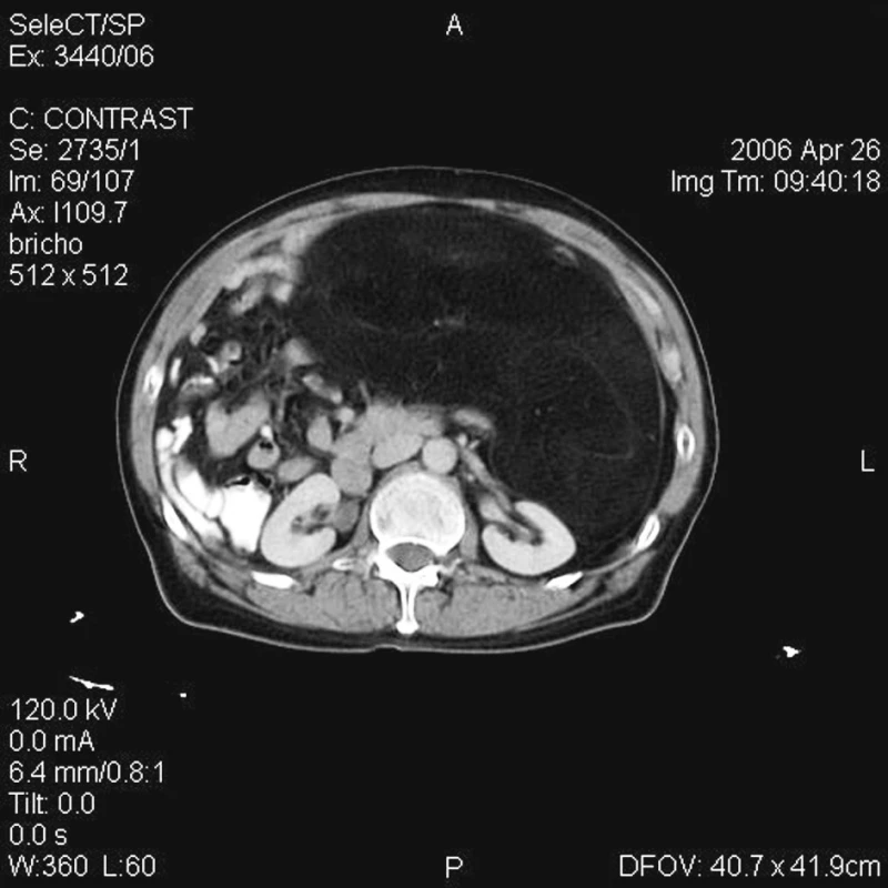 CT nález tumoru retroperitonea u pacientky č. 2
Fig. 2. A CT finding of the retroperitoneal tumor in the patient No. 2

