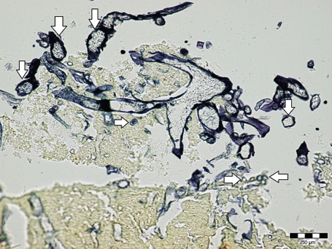 Endokard srdca s pomnoženými plesňami (zvislé šípky – sporangium, vodorovné šípky – spóry) (Grocott methenamin, zväčšenie 400x).