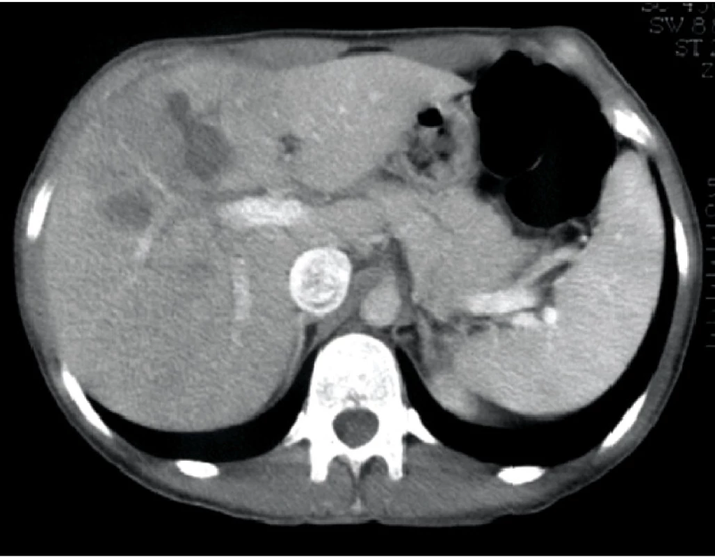 Kontrolní CT jater 28. den po úraze s poraněním jater III. stupně s nálezem zbytkového poúrazového defektu v parenchymu jater