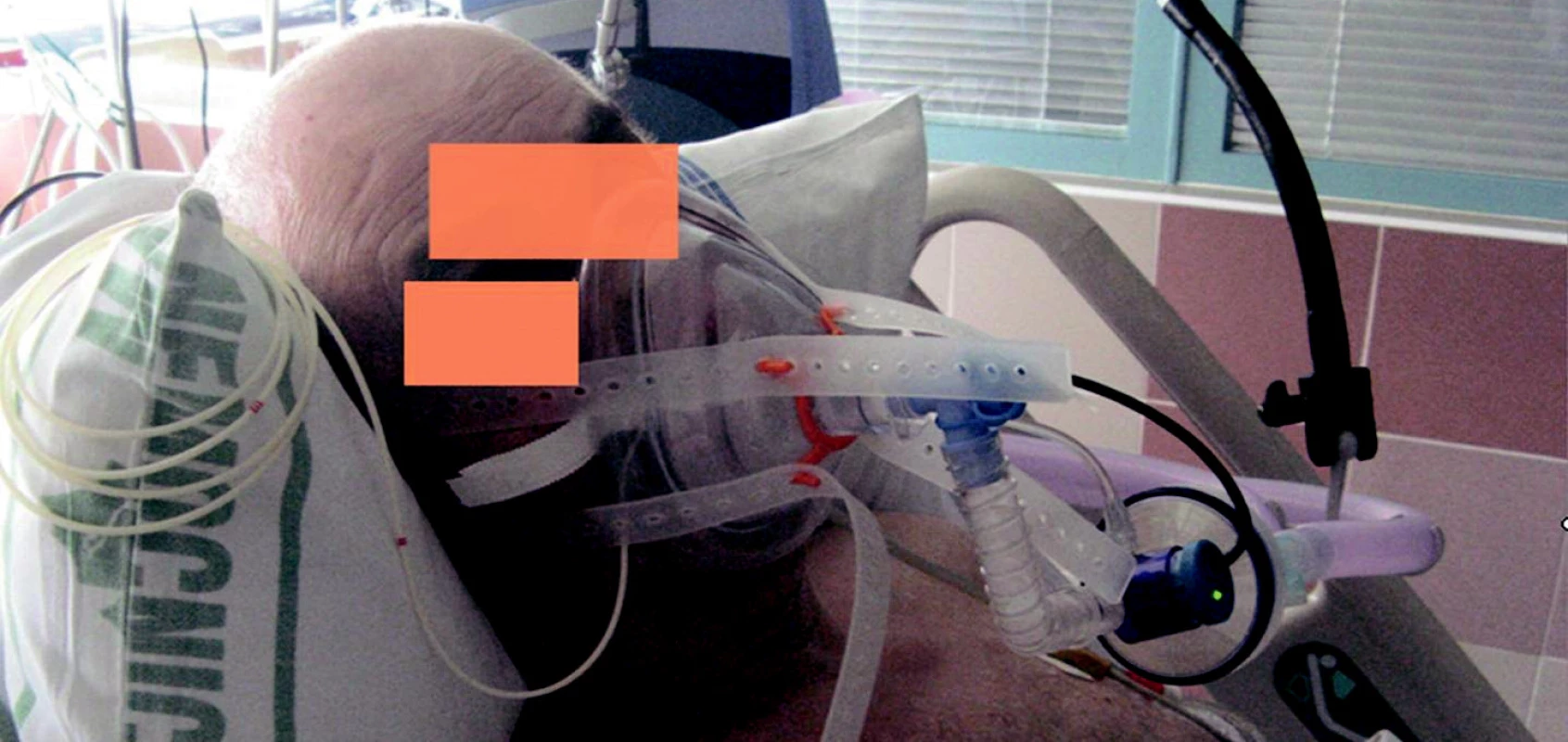 Anesteziologická maska fixovaná silikonovou ohlávkou, systém pasivního zvlhčení směsi
a ventilační asistence nemocničním ventilátorem po extubaci.