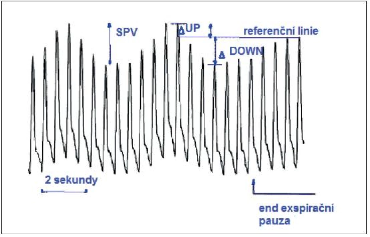 SPV – rozdíl mezi maximální a minimální hodnotou systolického tlaku během jednoho respiračního cyklu