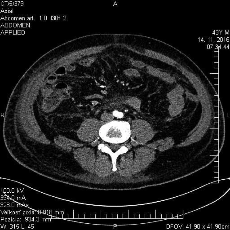CT brucha s nálezom mezenteriálnej
panikulitídy