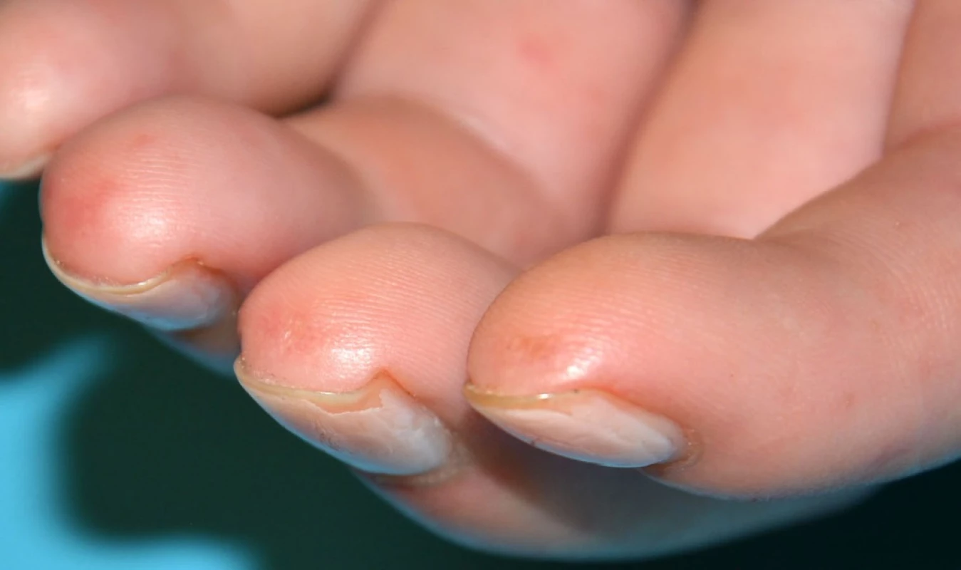 Jamkovité jizvičky na bříškách prstů u pacienta se systémovou sklerodermií