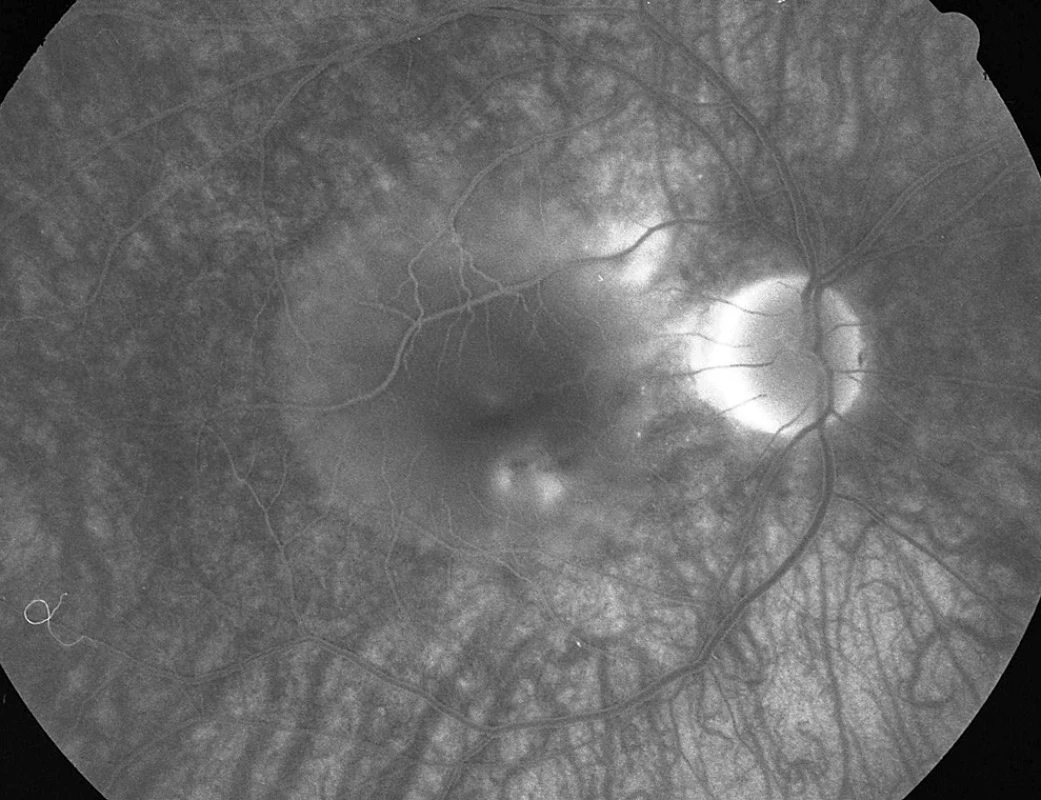 Pac. č. 5: Fluoresceínová angiografia PO: 3 body presakovania (pod centrom pri č. 5 a 6 a temporálne hore od TZN pri okraji ablácie neuroepitelu) pod rozsiahlu abláciu neuroepitelu retiny