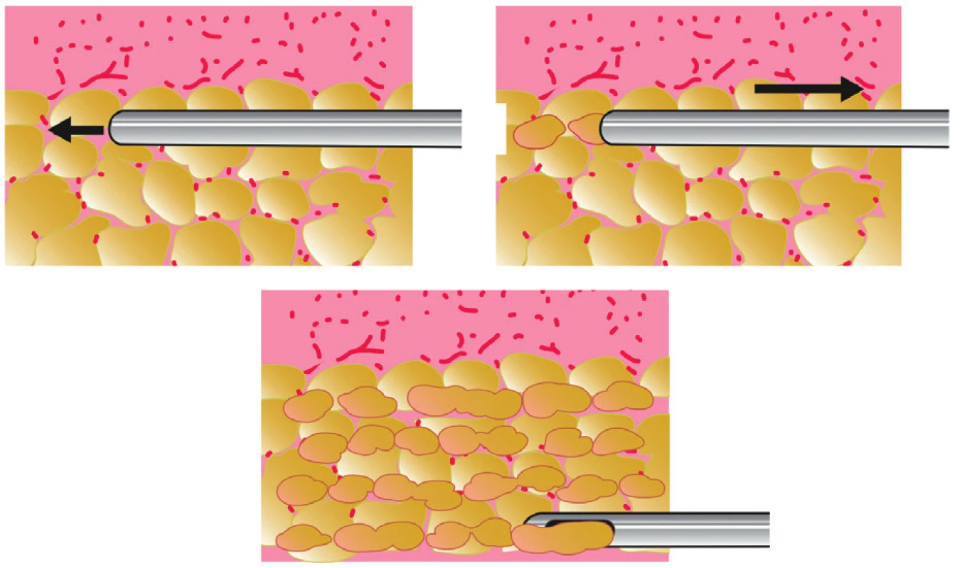Principle of fat transfer into multiple layers of recipient subcutaneous tissue