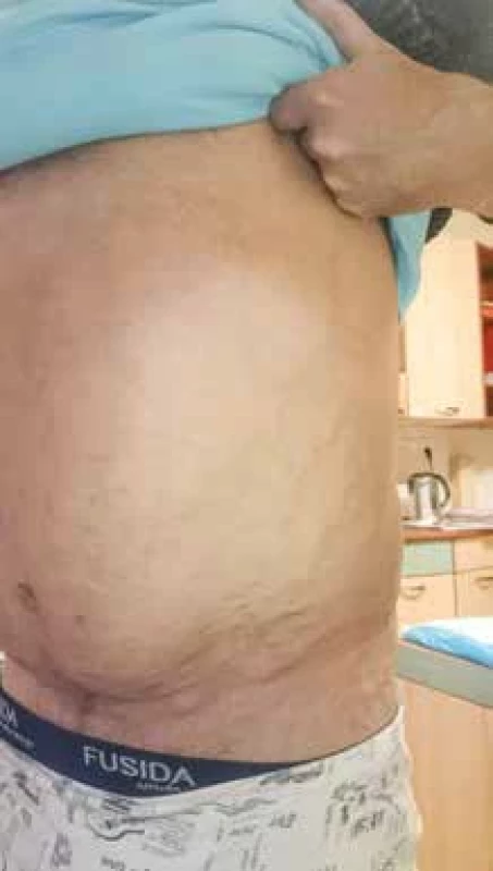 Žilní varixy v oblasti třísla a břicha u pacienta s uzávěrem dolní duté žíly a pánevních žil.