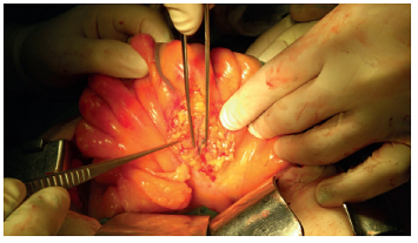 Znázornění lymfatik barvivem po otevření serózy
Fig. 3: Lymphatic vessels after visceral peritoneum opening