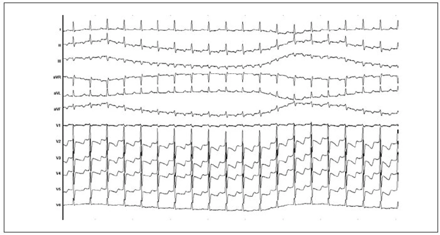 12svodový EKG-záznam atypické AVNRT. Jsou přítomny negativní P-vlny ve svodech II, III, aVF, přičemž PR-interval je krátký a RP-interval delší než PR-interval.