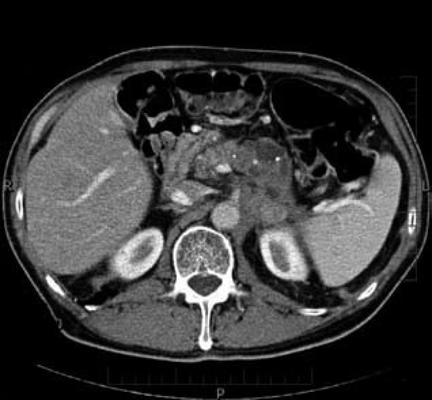 Karcinom těla a kaudy pankreatu – CT nález.
Fig. 2. Pancreatic body and tail carcinoma – CT finding.