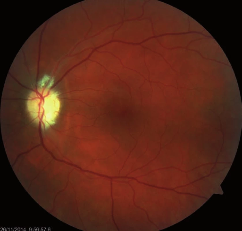 Regression of the optic nerve disc edema, one-month follow-up.