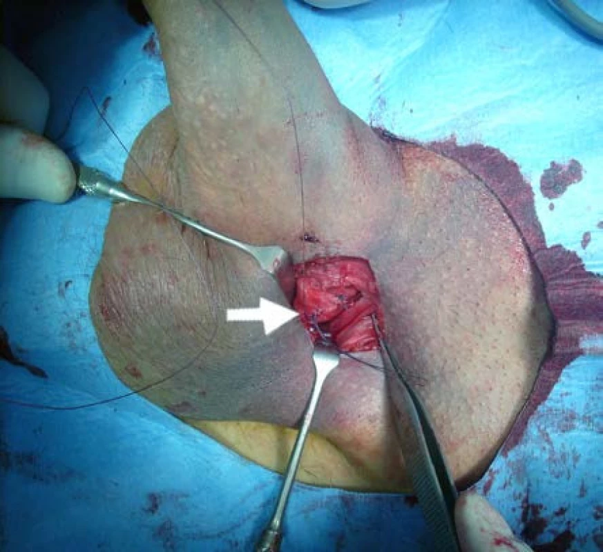 Sutura ruptury jednotlivými vstřebatelnými stehy Vicryl 3/0
Fig. 4. Suture of the rupture with single Vicryl 3/0 absorbable sutures