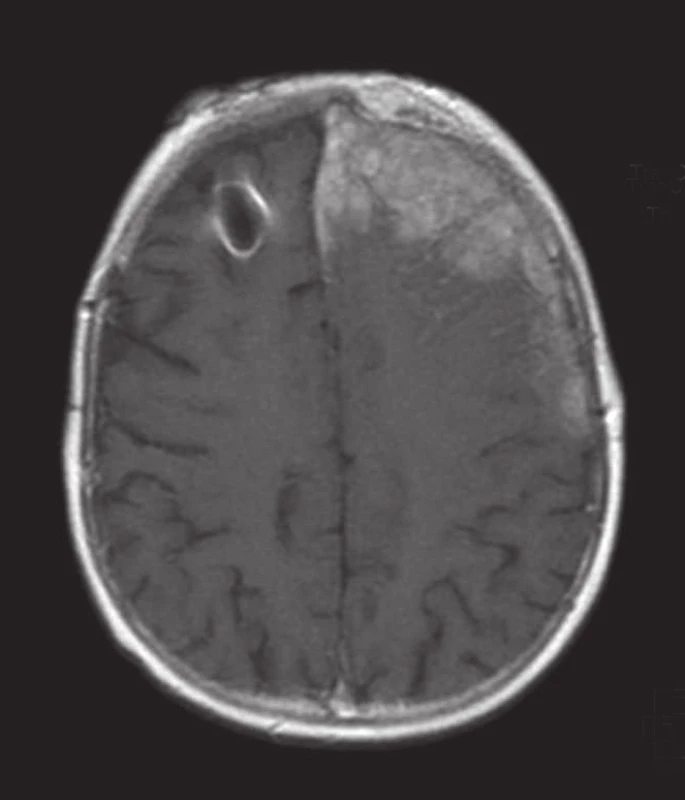 MRI mozgu, T1 vážený obraz postkontrastne, v sagitálnej (vľavo) a transverzálnej rovine (vpravo). Progresia ochorenia obojstranne frontálne, výraznejšie vľavo, aj s infiltráciou meningov, kosti a priľahlých mäkkých štruktúr. Šírenie infiltrátu v paranazálnych sinusoch vľavo - ethmoidálne, sphenoidálne, maxillárne. [14.04.2014]