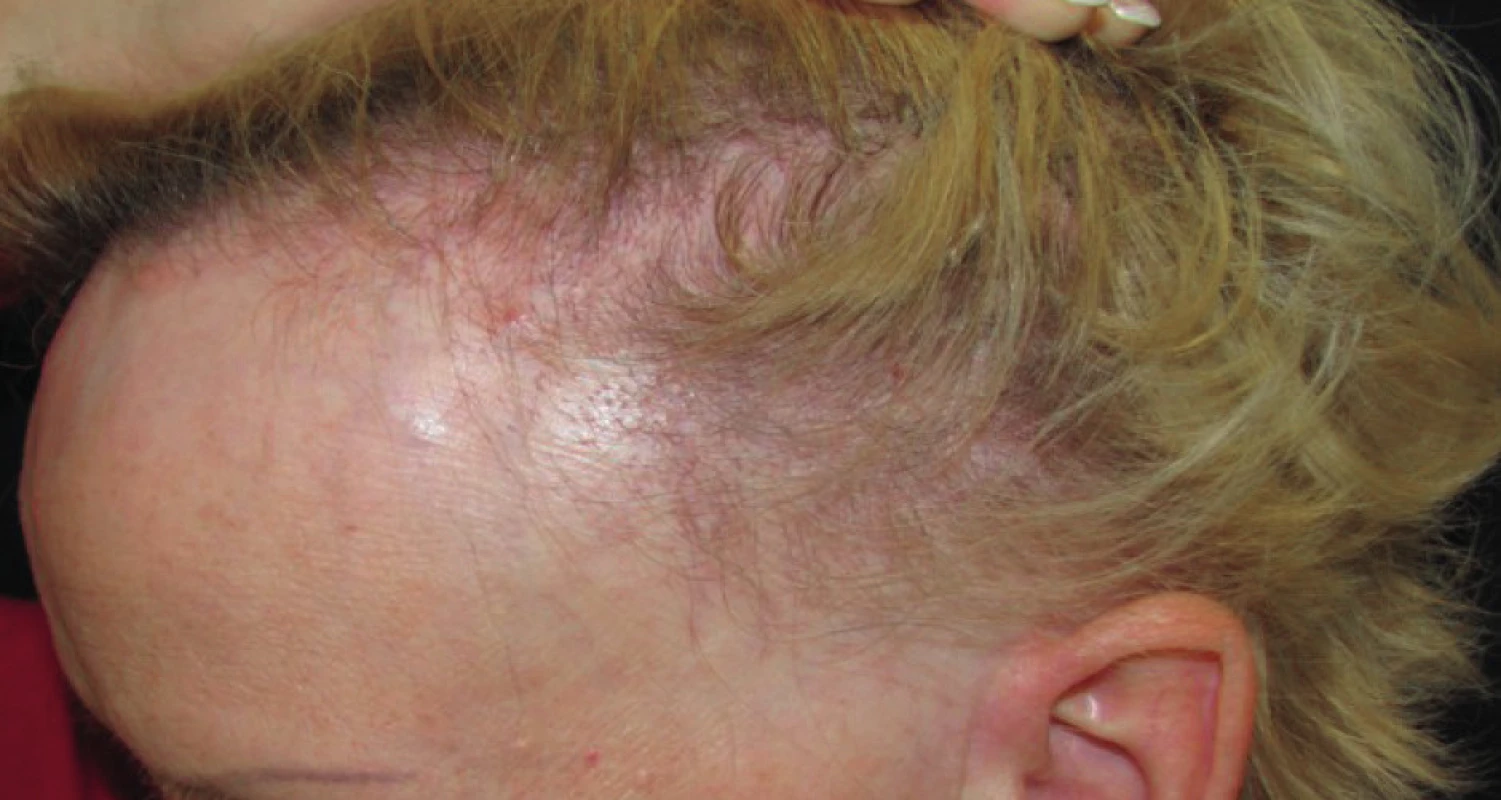 Mužský typ androgenetické alopecie – posunutá frontoparietální hranice a prohloubení frontálních koutů (mezoterapie neperspektivní, prognóza špatná)
