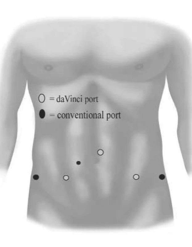 Konfigurace umístění portů při roboticky asistované laparoskopické radikální prostatektomii.