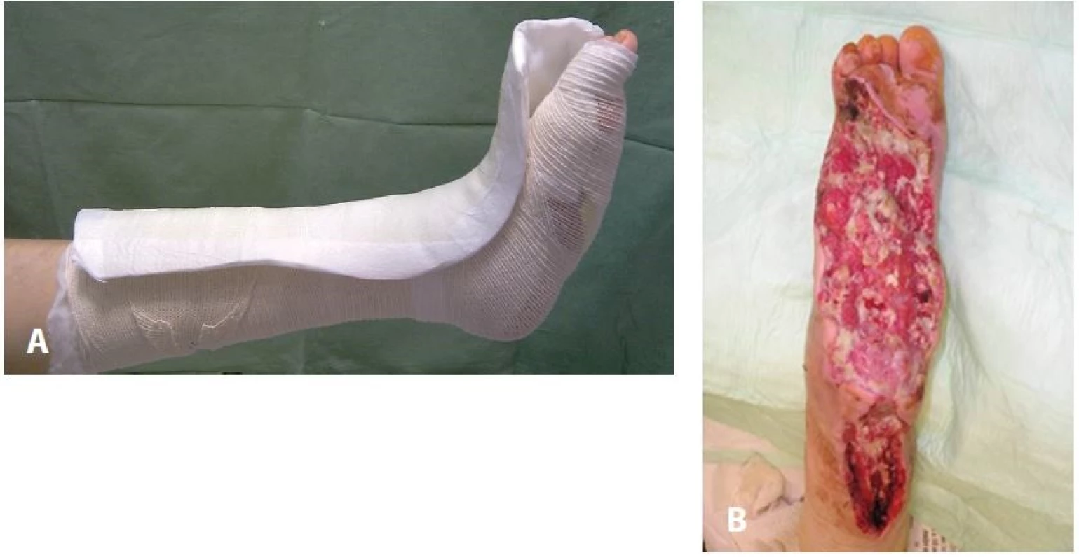 Pretibiální L-dlaha (A), často aplikovaná u rozsáhlých ztrátových postiženích dolní končetiny (B)
Fig. 6: Pretibial removable contact L-splint (A) often applicated after extensive debridements and necrectomies of the diabetic foot (B)