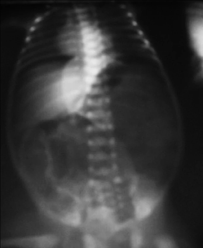 Kontrolná snímka po zavedení centrálneho venózneho katétra s obrazom pneumoperitonea.
Fig. 2. Control image after introduction of venous catheter with the picture of pneumoperitoneum.