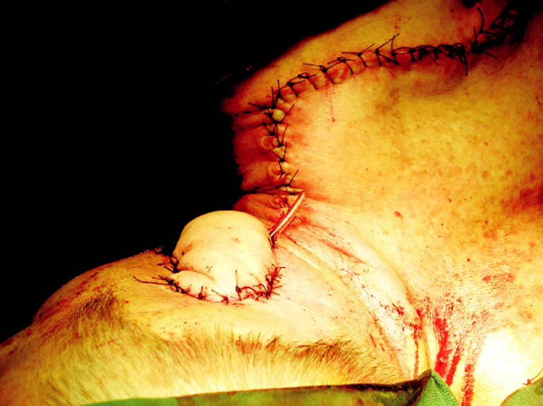 Umiestenie laloka a jeho sutúra v defekte. Sutúra donorského miesta na chrbte.