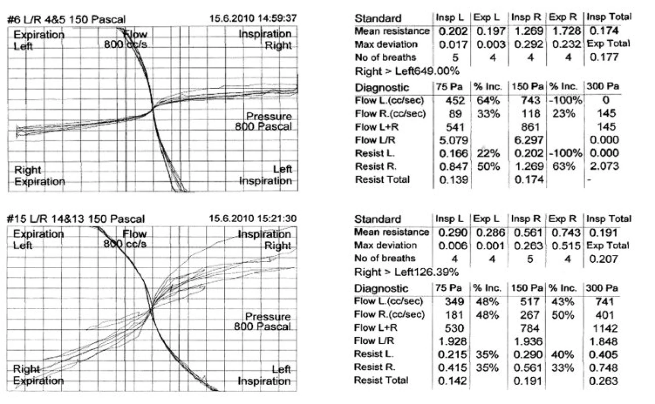 Kontralaterální rinomanometrie, horní graf před aplikací nafazolinu a 21 minut po něm, rezistence vpravo se signifikantně zmenšila.