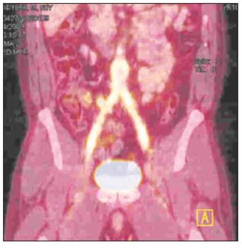 FDG-PET/CT obraz infekce aorto-bifemorální cévní protézy v celém jejím průběhu
Fig. 3. A totally infected aorto-bifemoral graft, as detected by FDG-PET/CT
