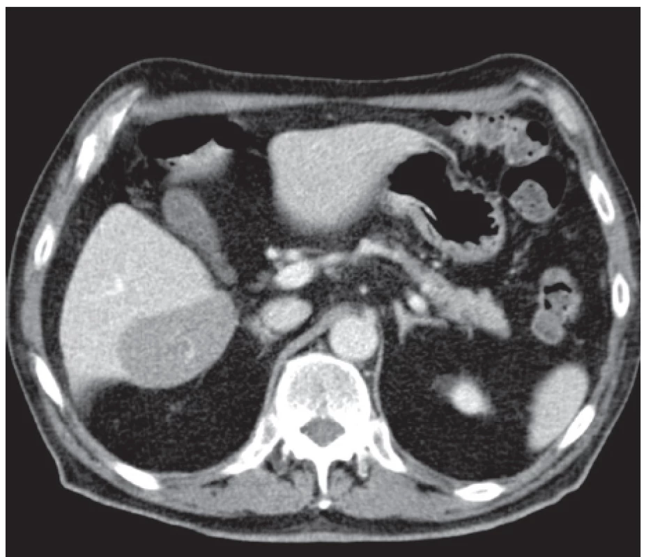 CT nález – tumorozní ložisko při dolním okraji jater
Fig. 1: CT findings – tumour at the lower margin of the liver