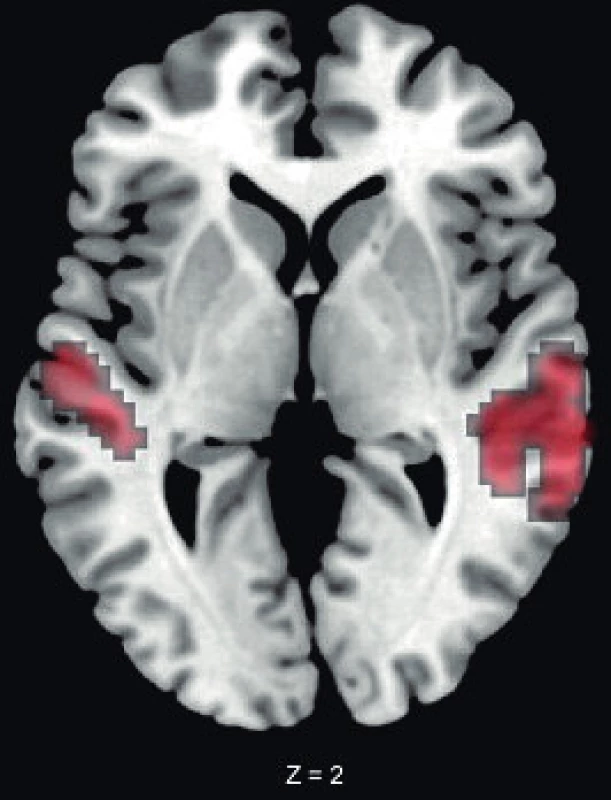Planum temporale – písmeno Z označuje výškovou souřadnici řezu v obrazu výpočetní tomografie, levá strana mozku odpovídá pravé straně obrázku