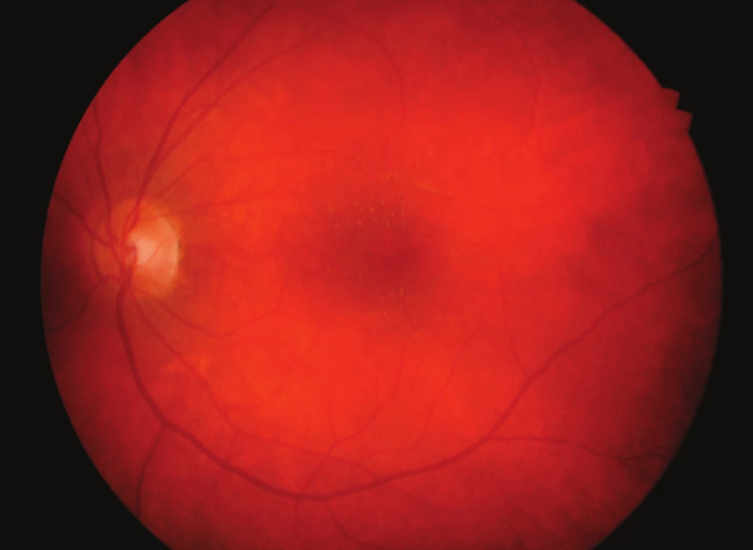 Hvězdicová makulopatie levého oka měsíc po léčbě
