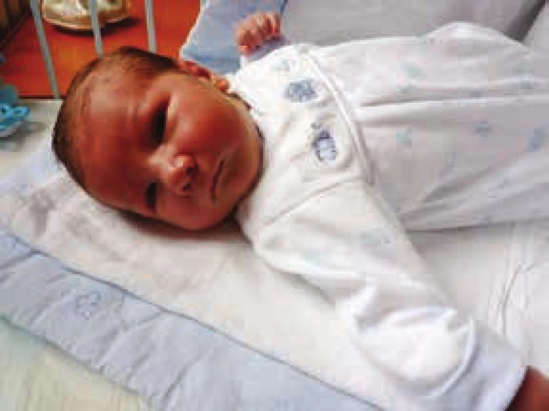 Zdravý novorozenec, chlapec narozený pacientce s ISZ v graviditě léčené adalimumabem