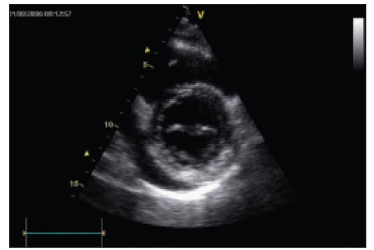 Echokardiografický nález u pacientky 2, perikardiální výpotek za zadní stěnou levé komory. Parasternální krátká osa, 2rozměrné zobrazení.