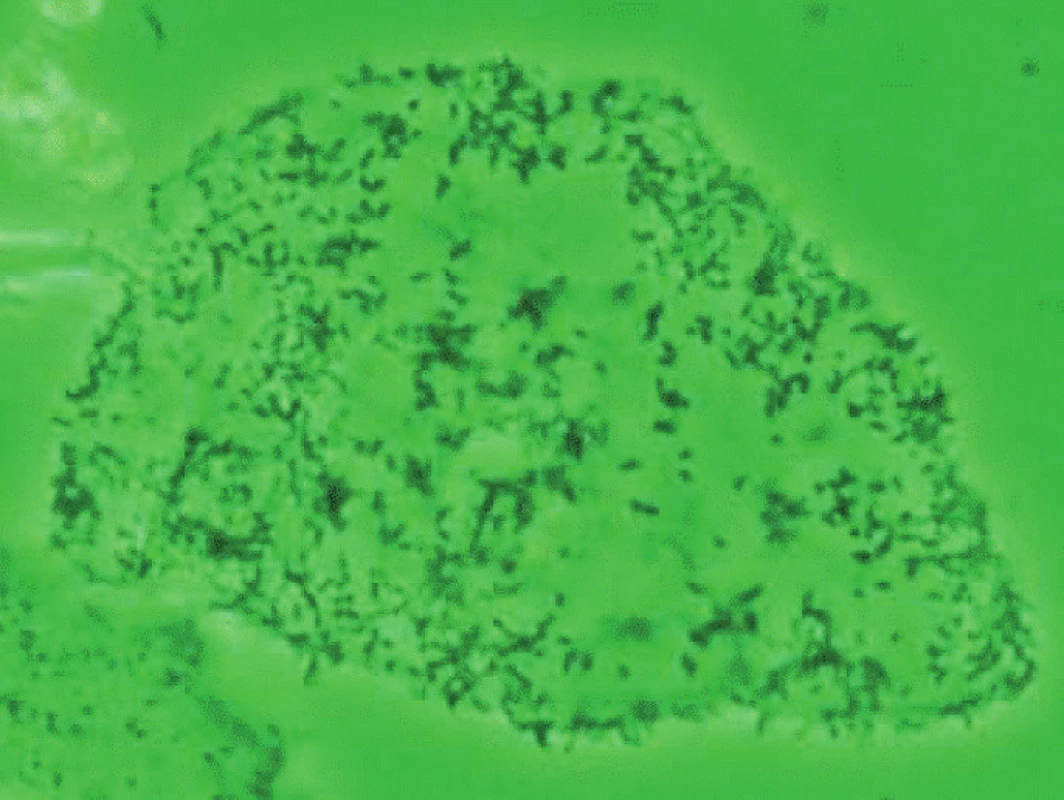 Klíčové buňky (clue cells) s adherovanými bakteriemi. Snímek z mikroskopu s fázovým kontrastem laskavě zapůjčil prof. Giovanni Miniello, Bari, Itálie.