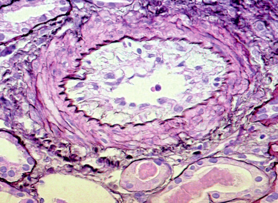 Svalová arterie malého kalibru se stenózující intimální mukoidní hyperplazií 
(barvení PASM [periodic acid – silver methenamine]; objektiv 40krát)
