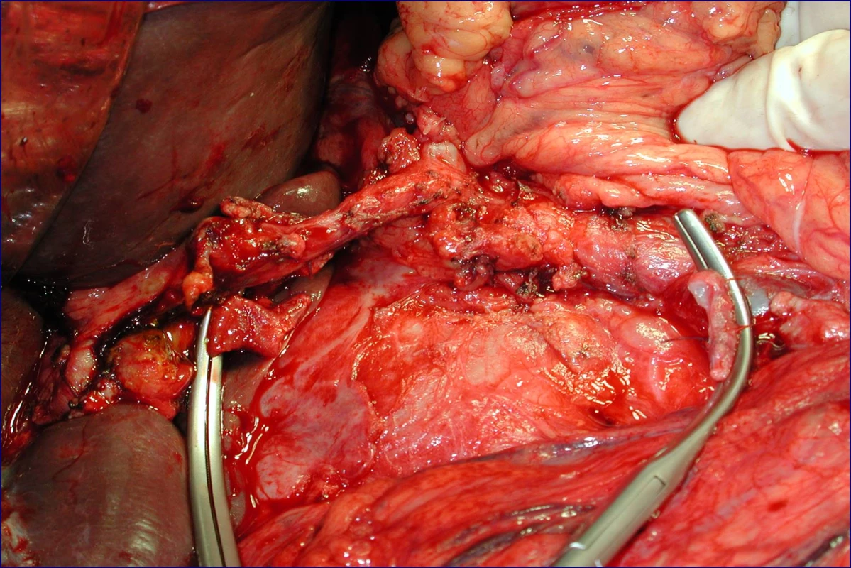 Stav po proximální pankreatoduodenektomii se standardní lymfadenektomií a resekci portomezenterického segmentu (peroperační foto)
