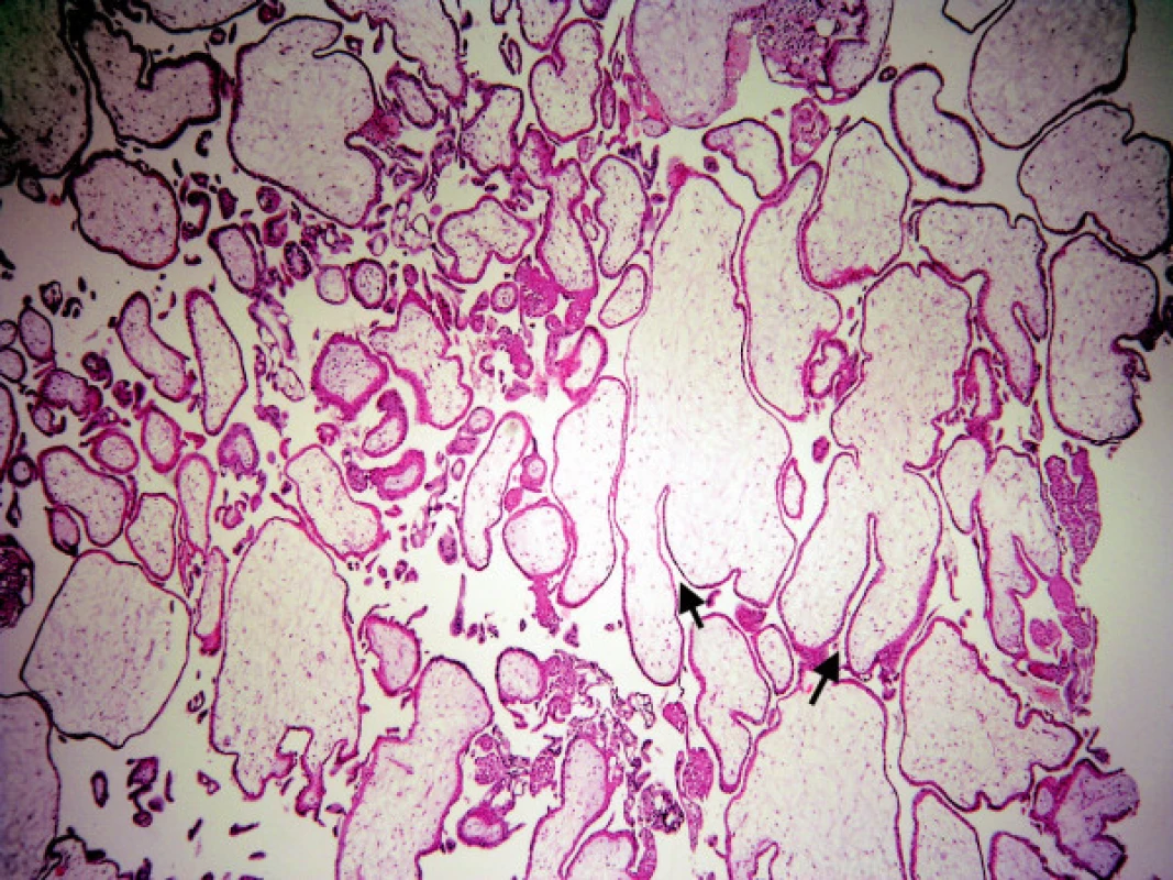 Mola hydatidosa partialis: hydropické i normální klky, lehká hyperplazie trofoblastu, hluboké, úzké „fjordovité“ invaginace (šipky)