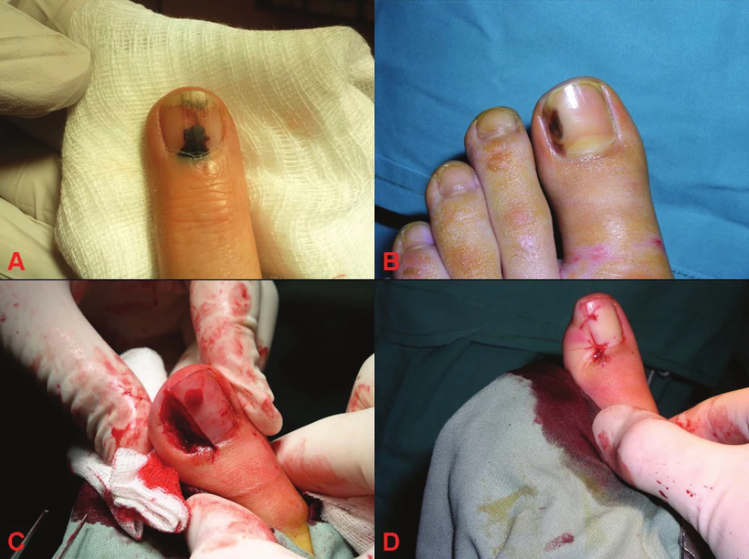 Subunguální hematom a subunguální melanom
A: subunguální hematom
B: subunguální melanom
C: peroperační snímek diagnostické excize subunguálního melanomu
D: stav po provedené diagnostické excizi subunguálního melanomu, po které následovala amputace prstu