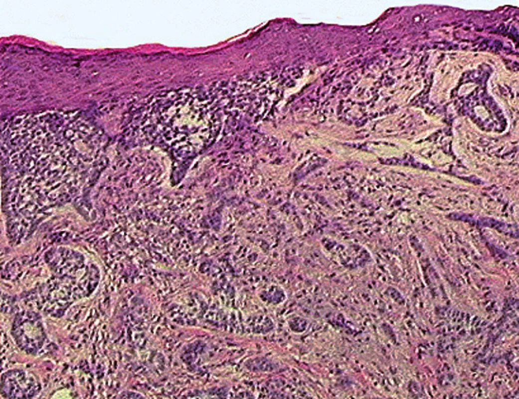 Histologický obraz infiltratívneho typu bazocelulárneho karcinómu kože pozostávajúceho z nepravidelných a neostro ohraničených zoskupení nádorových buniek infiltrujúcich dermu aj hlbšie tkanivové štruktúry (H&amp;E, zväčšenie 100×).
