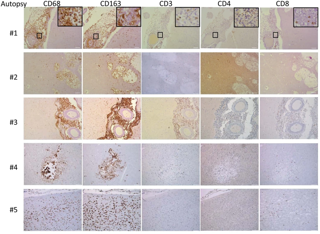 Brain immunohistochemistry staining of brain autopsy specimens from patients who died of s-CNS cryptococcosis demonstrate macrophage and T-cell tissue infiltration.