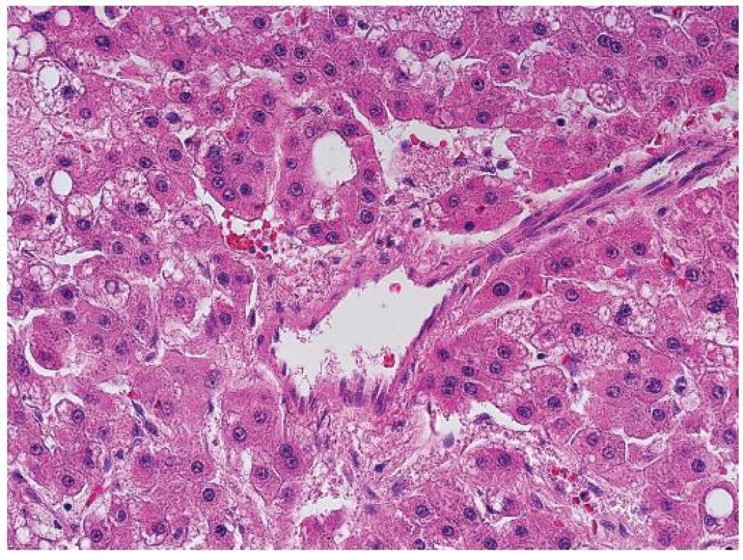 Nepárová artérie v centru je obklopená trámci nádorových hepatocytů. HE, zvětšení objektiv 40x.