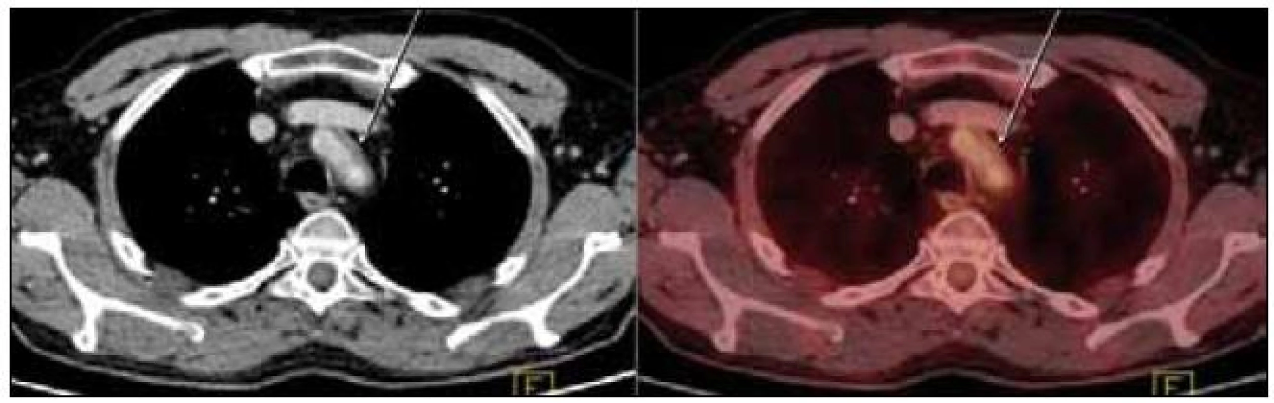 PET-CT zobrazení hrudníku. Zesílení stěny hrudní aorty v úrovni jejího oblouku na šíři 5 mm (označeno šipkami). Evidentní hypermetabolizmus glukózy neprokázán.