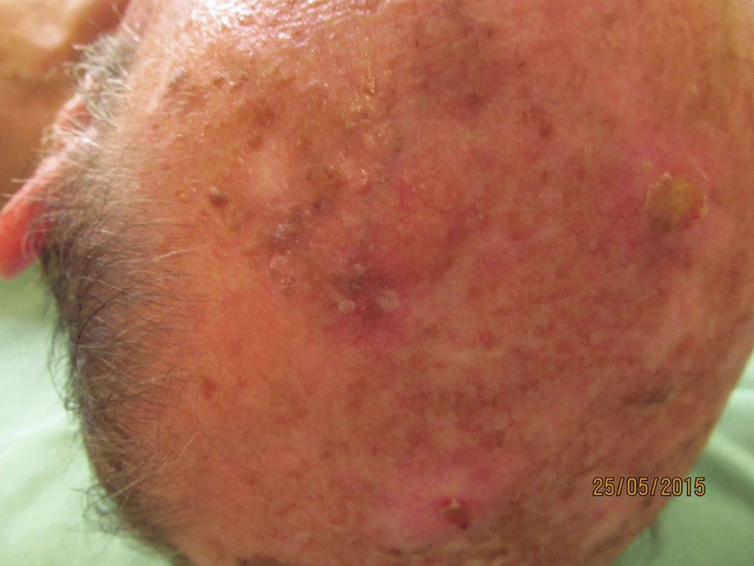 Klinický obraz v květnu 2015 – chronické poškození kůže temene hlavy UV zářením, seboroické veruky