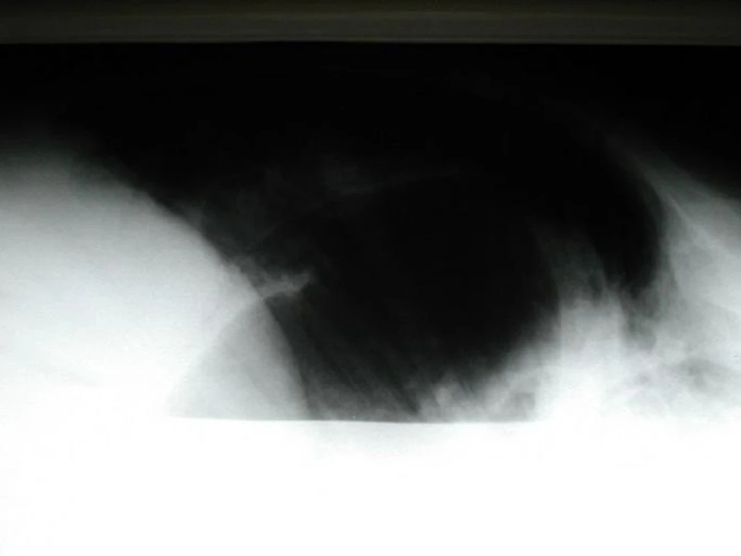Ruptura bránice vlevo - snímek vleže s kontrastní látkou v žaludku