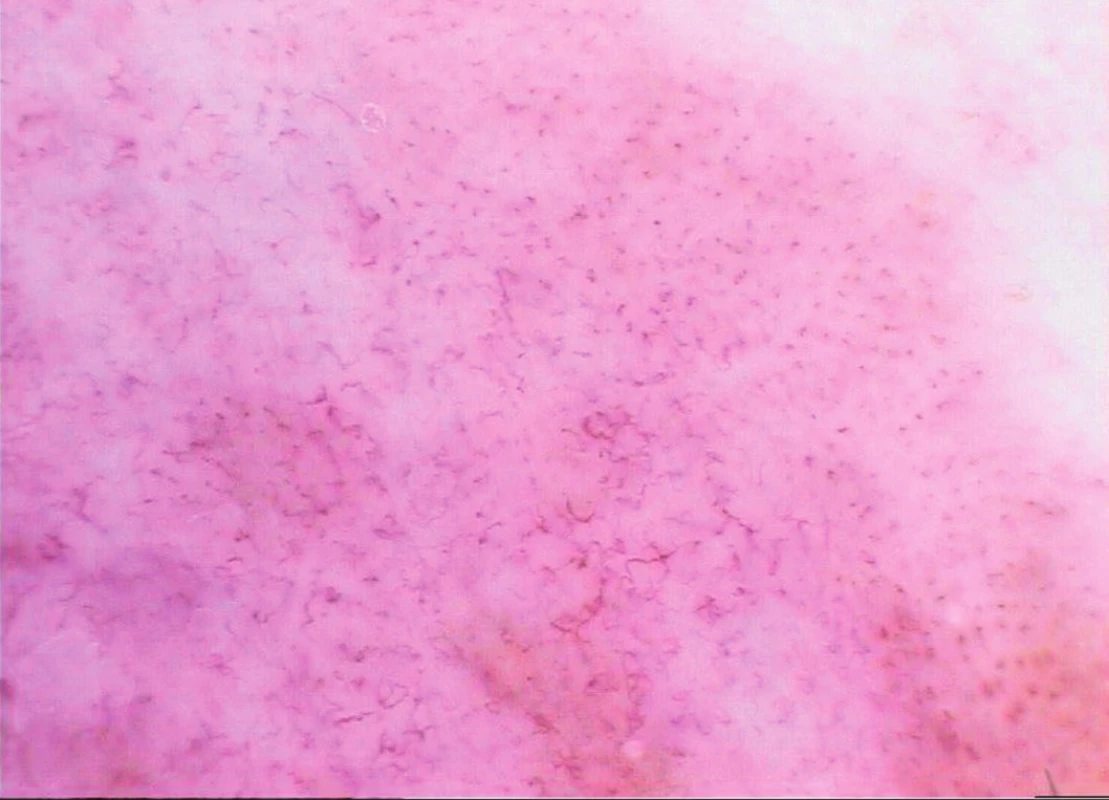 Tenký melanom (Breslow 0,1 mm)
Dermatoskopický obraz je kombinací převažujících tečkovitých cév s nepravidelnými lineárními ektaziemi.
