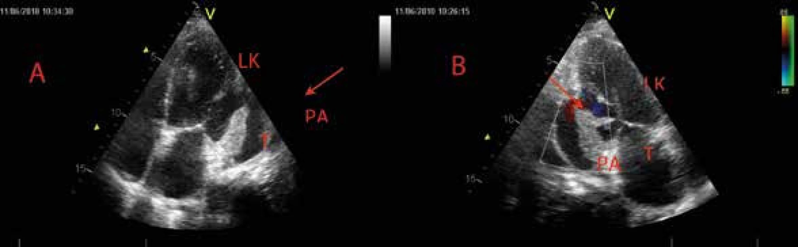 Parciálně trombotizované pseudoaneuryzma posterolaterální stěny levé komory – echokardiografie