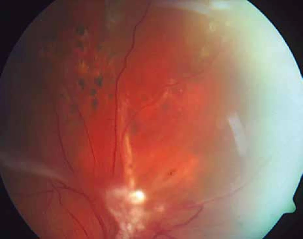 Pacient č. 2: Fundus oka pravého: pokročilá proliferativní diabetická retinopatie s komplikacemi – nahoře pigmentované stopy po laseru – oblast, kde sítnice leží.