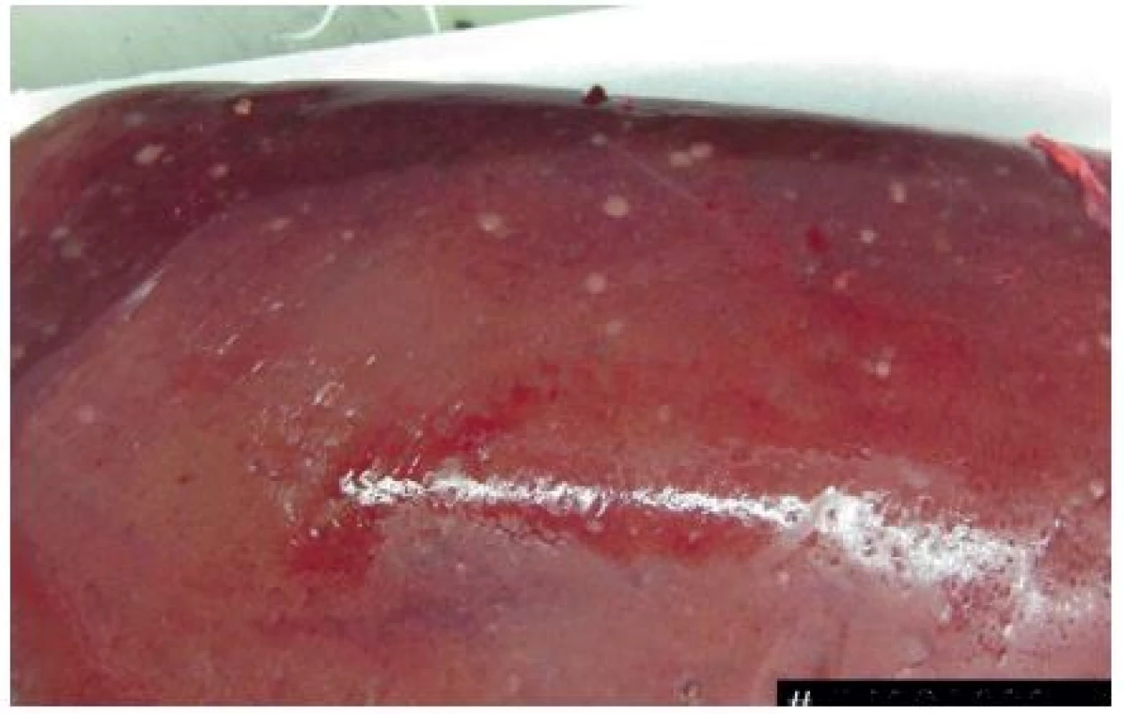 Resekovaný preparát pravostranné hemihepatektomie
Fig. 4: Resected liver – right hemihepatectomy