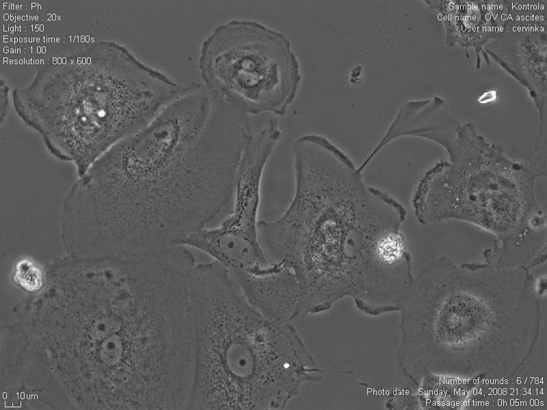 Nádorové buňky získané z ascitu (zvětšení 20x)