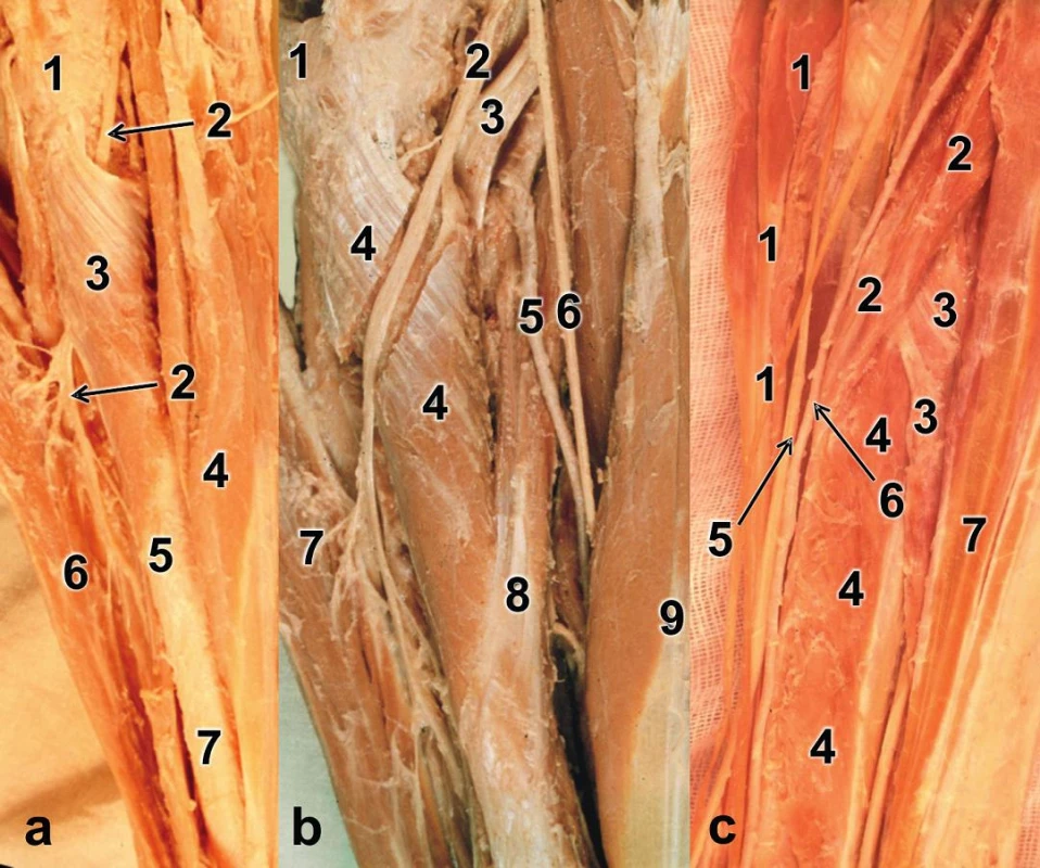 Začátky a úpony svalů na radiu (preparát pravé strany): a – proximální polovina radia, 
1 – kloubní pouzdro kryjící hlavici radia, 2 – r. profundus n. radialis, 3 – m. supinator, 4 – m. flexor carpi radialis, 5 – úpon m. pronator teres, 6 – m. extensor digitorum,  7 – diafýza radia; b – proximální polovina radia s vypreparovným canalis supinatorius, 1 – kloubní pouzdro kryjící hlavici radia, 2 – r. profundus n. radialis, 3 – šlacha m. biceps brachii, 4 – m. supinator s vypreparovaným canalis supinatorius, 5 – a. radialis odtažená mediálně, 6 – r. superficialis n. radialis odtažený mediálně, 7 – m. extensor digitorum, 8 – m. pronator teres, 9 – m. flexor carpi radialis; c – střední třetina radia, 1 – m. brachioradialis, 2 – m. pronator teres, 3 – m. flexor digitorum superficialis (caput radiale), 4 – m. flexor pollicis longus, 5 – r. superficialis n. radialis, 6 – a. radialis, 7 – m. flexor carpi radialis.
Fig. 5: Muscle origins and insertions on radius (right side specimen): a – proximal half of radius, 
1 – joint capsule enveloping radial head, 2 – deep branch of radial nerve, 3 – supinator, 4 – flexor carpi radialis, 5 – insertion of pronator teres, 6 – extensor digitorum, 7 – radial shaft; b – proximal half of radius with dissected canalis supinatorius, 1 – joint capsule covering radial head, 2 – deep branch of radial nerve, 3 – biceps brachii tendon, 4 – supinator with dissected canalis supinatorius, 
5 – radial artery retracted medially, 6 – superficial branch of radial nerve, 7 – extensor digitorum, 
8 – pronator teres, 9 – flexor carpi radialis; c – the middle third of radius, 1 –  rachioradialis, 
2 – pronator teres, 3 – flexor digitorum superficialis (radial head), 4 – flexor pollicis longus, 
5 – superficial branch of radial nerve, 6 – radial artery, 7 – flexor carpi radialis.