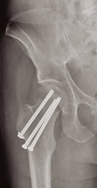 Zlomenina krčku femuru řešena OS třemi kanulovanými šrouby