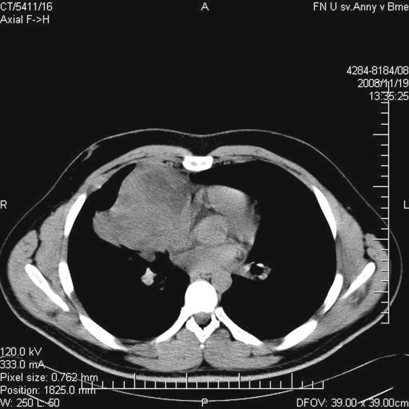 CT hrudníku při punkci pro histologickou verifikaci infiltrátu
Fig. 2. The thorax CT-scan during the fine needle biopsy